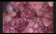 Enucleacion Laparoscopica de Insulinoma de Cuello Pancreatico