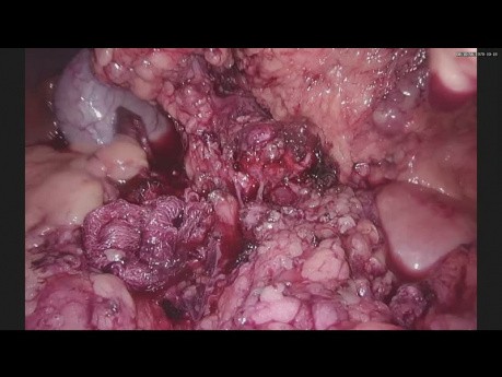 Enucleacion Laparoscopica de Insulinoma de Cuello Pancreatico