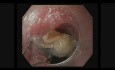 Extracción de cuerpo extraño esofágico en el tracto gastrointestinal superior