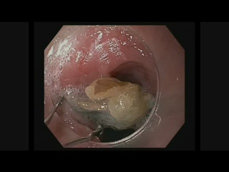Extracción de cuerpo extraño esofágico en el tracto gastrointestinal superior