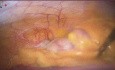 Apendicitis aguda con embarazo con hernia inguinal oblicua derecha y colelitiasis previa