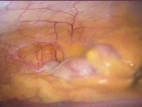 Apendicitis aguda con embarazo con hernia inguinal oblicua derecha y colelitiasis previa