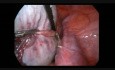 Laparoscopia para teratoma gigante