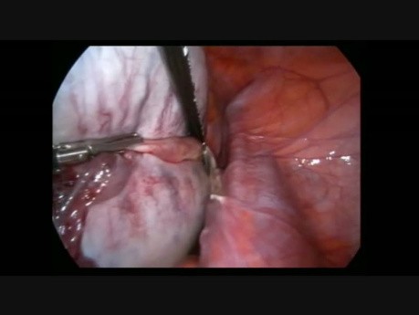 Laparoscopia para teratoma gigante