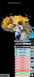 Planificación quirúrgica con neuronavegador en paciente con lesión de masa intracraneal. Glioma de alto grado.