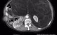 Liposarcoma Retroperitoneal TAC