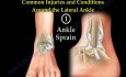 Anatomía y lesiones del tobillo lateral