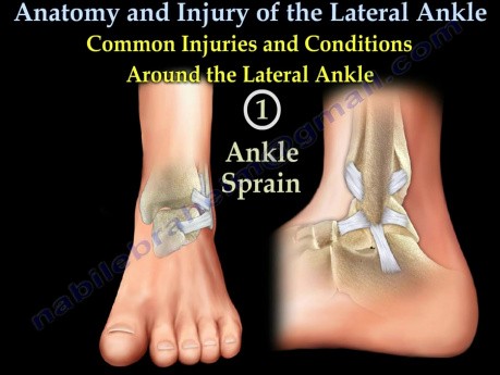Anatomía y lesiones del tobillo lateral