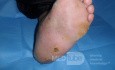 Pie de Charcot izquierdo con úlcera plantar