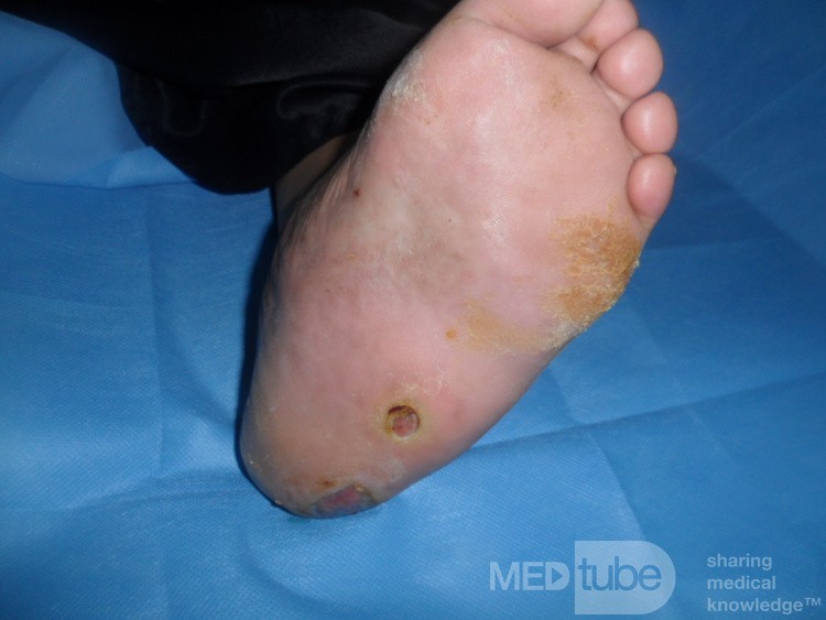 Pie de Charcot izquierdo con úlcera plantar