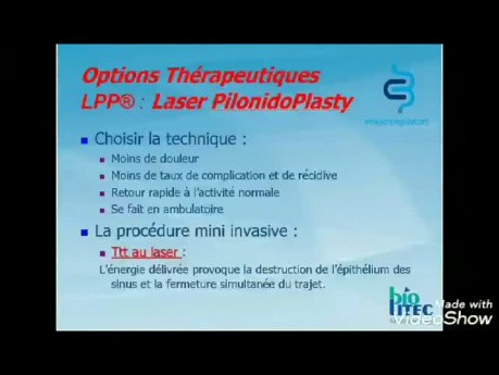 Tratamiento con láser del seno pilonidal