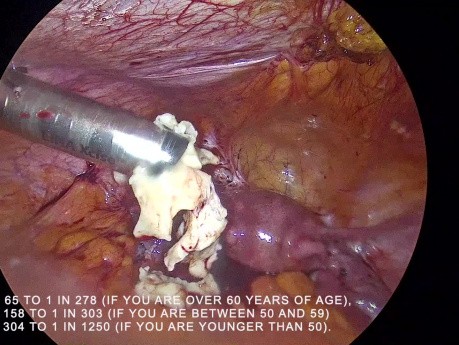 Morcelación contenida versus no contenida del fibroma