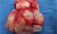 Fibroadenoma gigante de mama