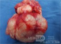 Fibroadenoma gigante de mama