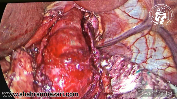 Miotomía para la acalasia