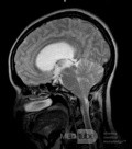 Tercera ventriculostomía endoscópica en un caso benigno de síndrome de Aicardi con hidrocefalia obstructiva y malformación de Chiari tipo 1