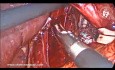 Reparación laparoscópica de hernia de hiato deslizante