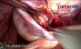 Bilateral Chocolate Cyst with Rectovaginal Nodules