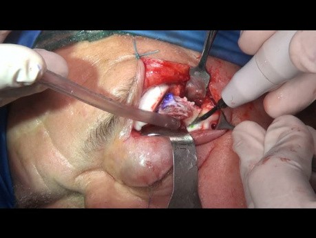 Reconstrucción primaria con implante de una malformación venosa intraósea del borde lateral de la órbita