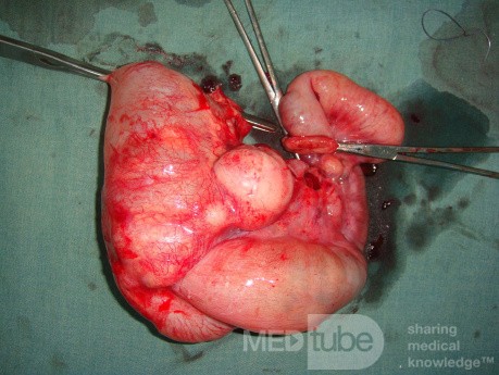 Intususcepción, linfoma no Hodgkin - hemicolectomía derecha