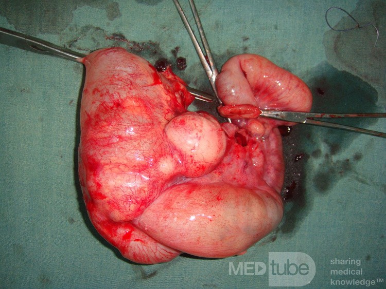 Intususcepción, linfoma no Hodgkin - hemicolectomía derecha