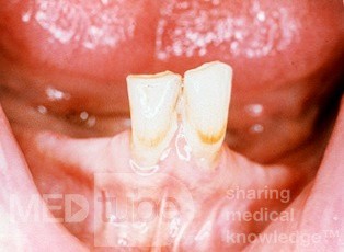 Reabsorción mandibular
