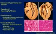 Evaluación ecocardiográfica de la miocardiopatía hipertrófica (MCH)