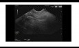 Ecografía endoscópica de la estenosis papilar
