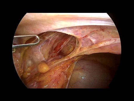 TAPP Historia Médica de Diverticulitis