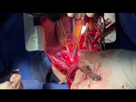 Cómo realizar fácilmente una endarterectomía pulmonar con TCA bilateral