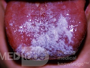 Leucoplasia [Candidiasis]