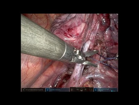 Segmentectomía anatómica S7+8