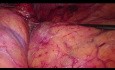 Adrenalectomía transperitoneal laparoscópica izquierda para metástasis del carcinoma pulmonar no microcítico (CPNM) - Video completo