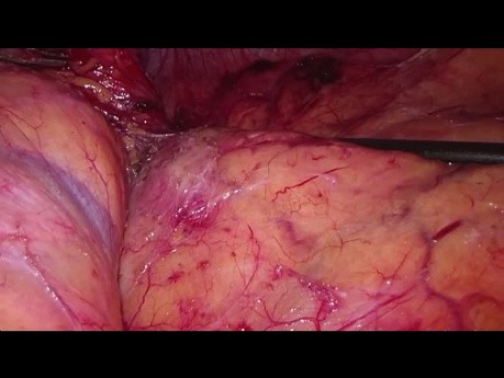 Adrenalectomía transperitoneal laparoscópica izquierda para metástasis del carcinoma pulmonar no microcítico (CPNM) - Video completo