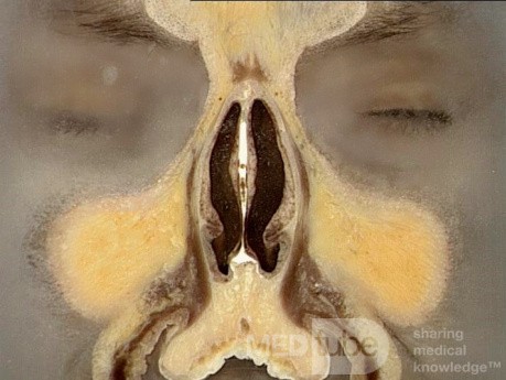 Anatomía coronal de la nariz y los senos paranasales: Corte 2