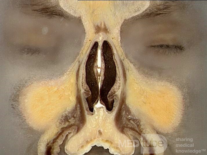Anatomía coronal de la nariz y los senos paranasales: Corte 2