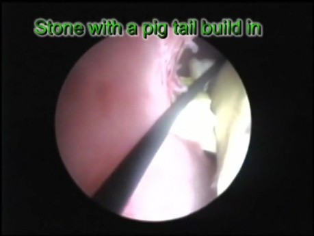 PCNL - Stent ureteral en forma de cola de cerdo