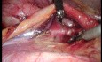 Estenosis pieloureteral izquierda. Pieloplastia laparoscópica.