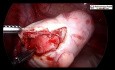 Cómo realizar una cistectomía ovárica dermoide segura sin derrames