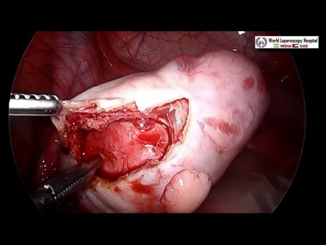 Cómo realizar una cistectomía ovárica dermoide segura sin derrames