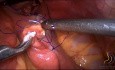 Gastrectomía subtotal laparoscópica (con linfadenectomía D2)