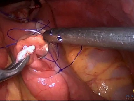 Gastrectomía subtotal laparoscópica (con linfadenectomía D2)