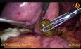 Colecistectomía laparoscópica, coledocoscopia y extracción de cálculos del conducto biliar común (CBC)