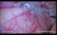 Reparación laparoscópica de hernia inguinal: TAPP. Una descripción paso a paso.