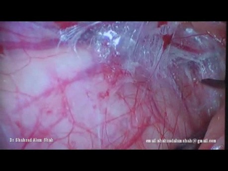 Reparación laparoscópica de hernia inguinal: TAPP. Una descripción paso a paso.