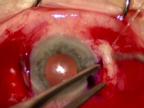 Vitrectomía Pars Plana 25G + Implante de LIO Soleko Carlevale Mediante Técnica "Scleral Pocket"