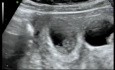 Reducción del feto transvaginal de un embarazo cuatrillizo monocoriónico