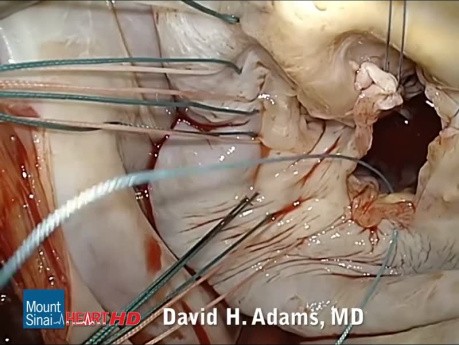Reparación de la válvula mitral por deficiencia fibroelástica con rotura de cuerdas y prolapso de P2
