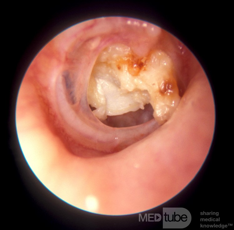 Colesteatoma que sale de una perforación subtotal