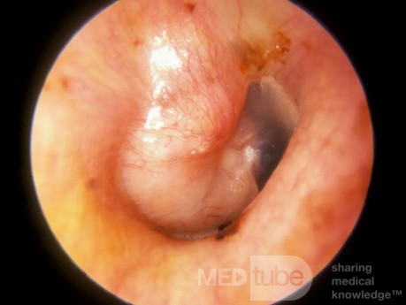 Adenoma primario del oído medio